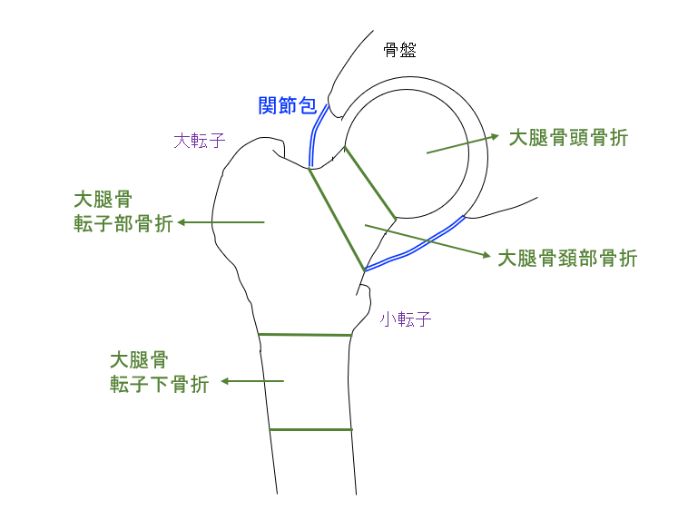 図_大腿骨近位部骨折の分類