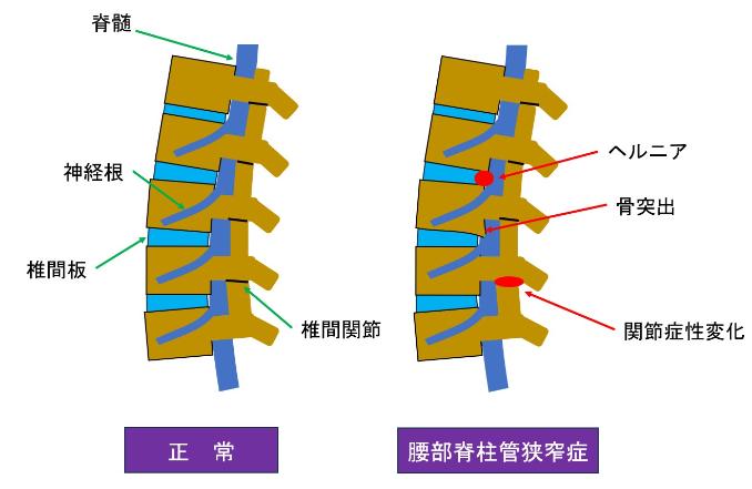 図1_正常な脊柱・脊柱管と脊柱管狭窄症.jpg
